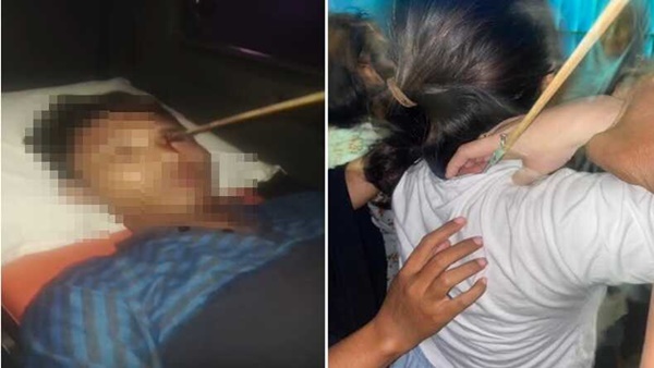 Tak Hanya Perempuan, Pemuda di Tallo Tertancap Busur Panah di Mata