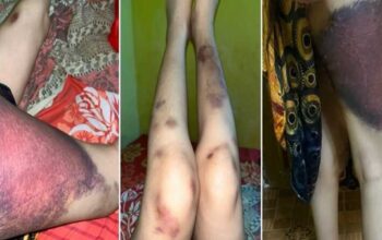 IRT Hamil 5 Bulan di Bulukumba Disiksa Suami, Foto Lebam Viral di Instagram